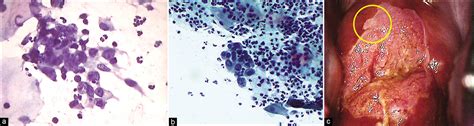 mild inflammation on pap smear|inflammatory associated cellular changes pap.